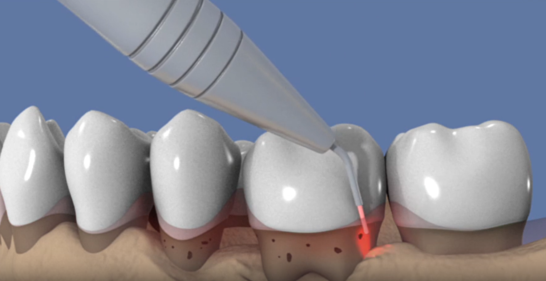 Le laser en soins dentaires