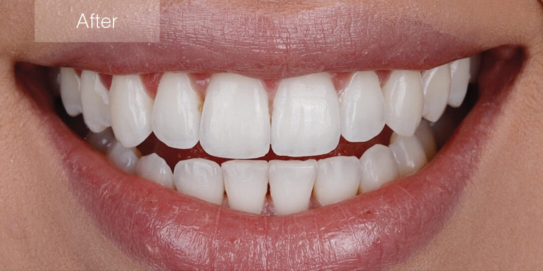 aligneurs d'orthodontie